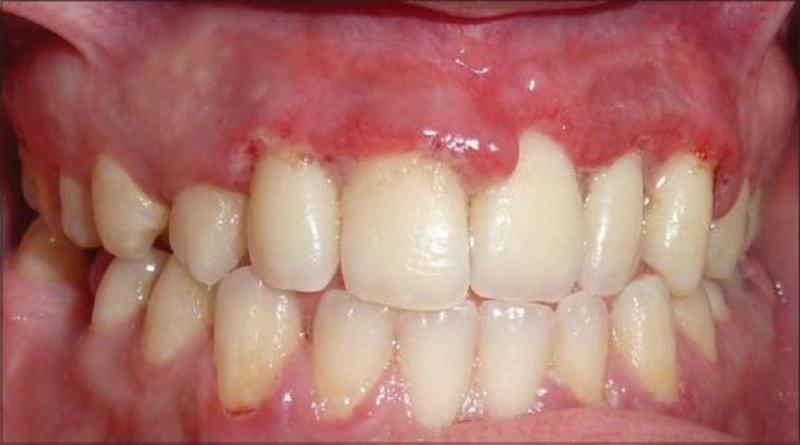 Đây là tình trạng chung gây nhiễm trùng nướu răng tiến triển rất nhanh chóng do sự tích tụ bởi vi khuẩn có trong khoang miệng