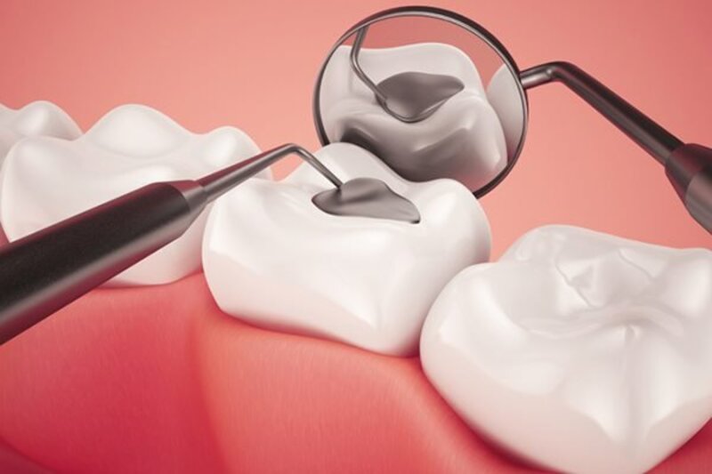 Việc hàn trám răng sâu nếu không cần sử dụng đến thuốc tê