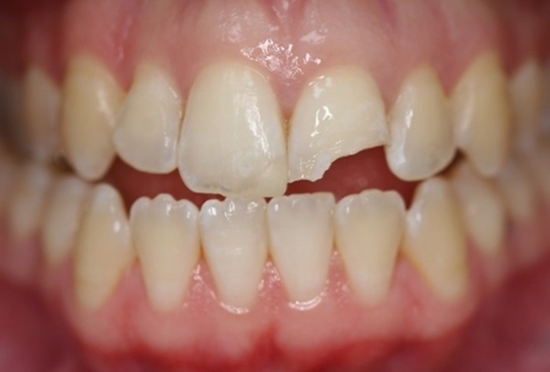 Khả năng chống lại tình trạng sâu răng ở mỗi người còn do kết cấu răng