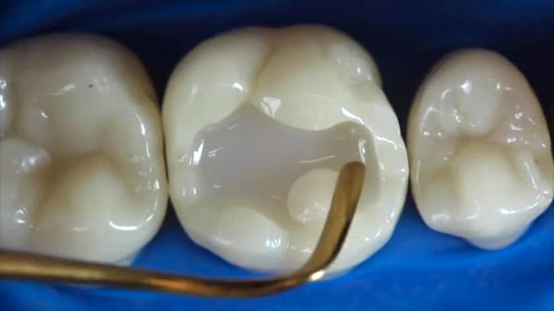 Hàn răng để có thể loại bỏ đi những vi khuẩn có trong khoang miệng