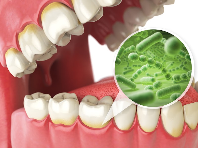 Sâu răng là do vi khuẩn Streptococcus Mutans