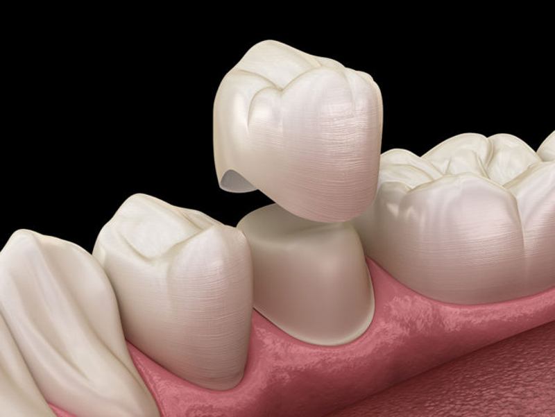 Khi răng số 6 bị hư hại nặng người bệnh có thể bọc răng sứ để bảo tồn răng.