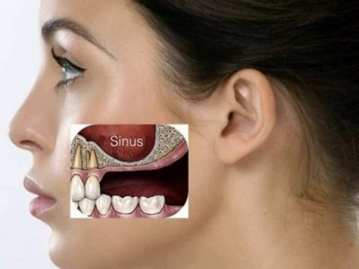 Sâu răng viêm xoang có liên quan gì?
