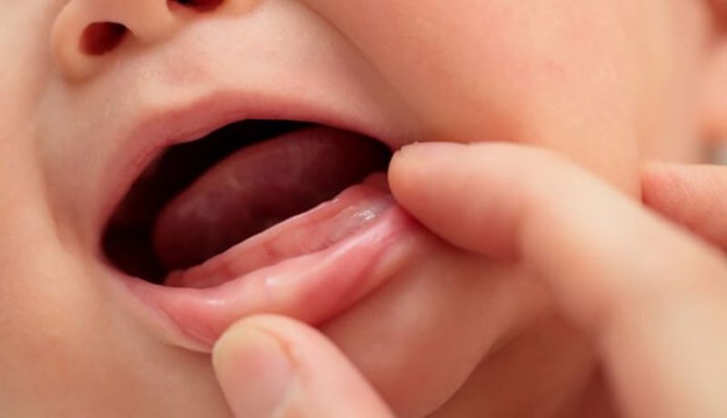 Trẻ 11 tháng chưa mọc răng có thể do nguyên nhân di truyền hoặc sinh thiếu tháng