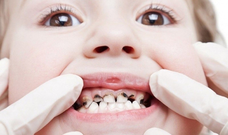 Sâu răng sữa sớm là hệ quả của việc trẻ mọc răng muộn