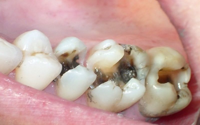 Tình trạng răng sâu lớn có thể sử dụng phương pháp bọc răng sứ để khắc phục