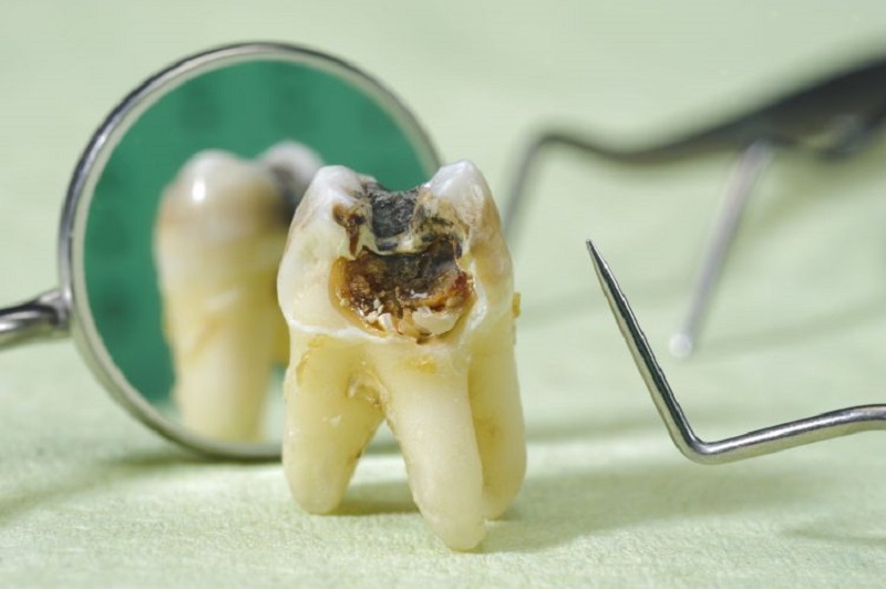 Bác sĩ sẽ tiến hành nhổ bỏ răng sâu nếu thấy cần thiết, hạn chế biến chứng nguy hiểm