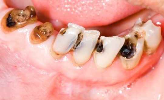 Sâu răng dẫn đến ung thư khiến nhiều người lo lắng