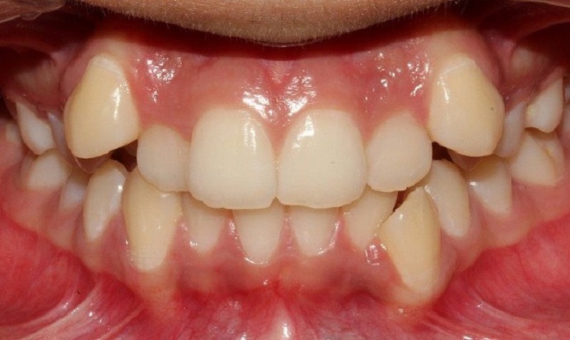 Bọc răng sứ cho răng khểnh được áp dụng khi răng bị khểnh ở mức độ nhẹ và trung bình