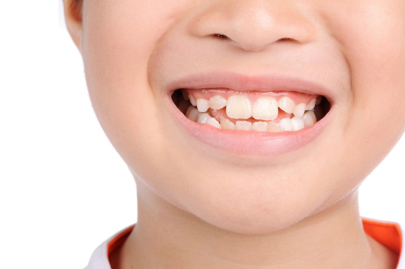 Bọc răng sứ cho răng mọc lệch Răng nếu như chỉ mọc lệch ở mức độ nhẹ mới có thể cải thiện bằng kỹ thuật bọc răng sứ