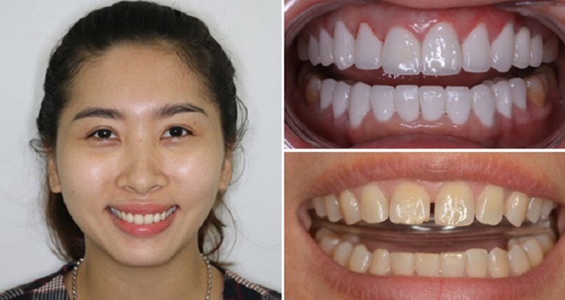 Hình ảnh trước và sau khi bọc răng sứ cho răng thưa