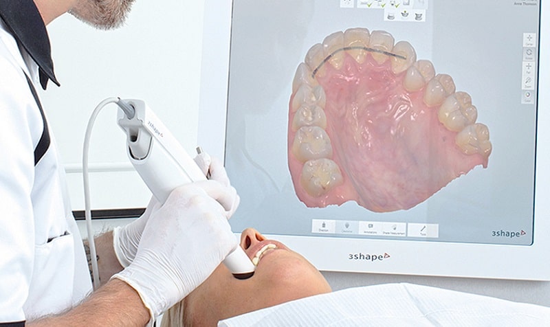 Lấy dấu răng bằng công nghệ kỹ thuật số 3Shape 3D