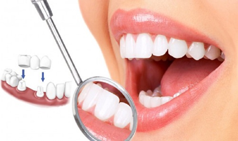 Răng sau khi được bọc sứ vừa đảm bảo tính thẩm mỹ vừa cải thiện khả năng ăn nhai