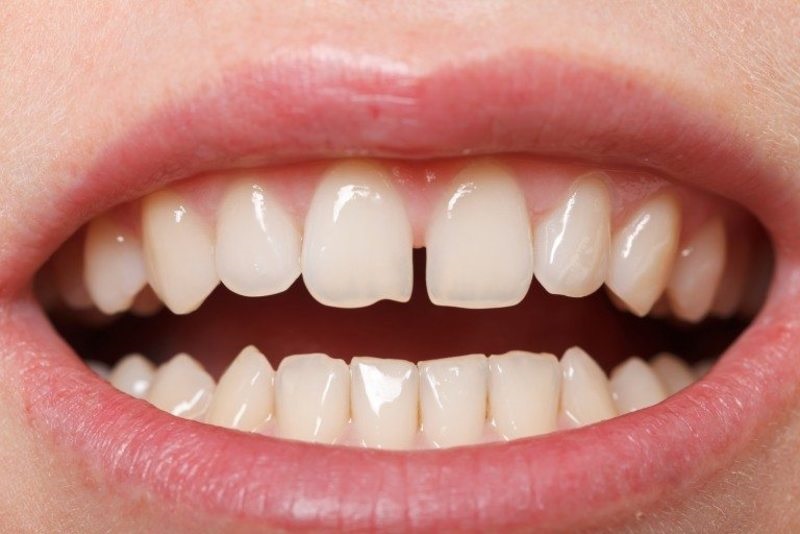 Răng của bị thưa là trường hợp nên bọc răng sứ