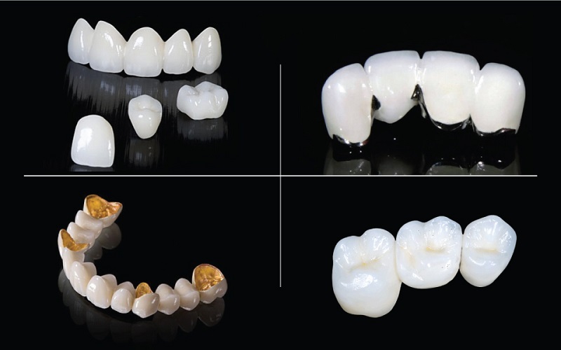 Giá bọ sứ cho răng của phụ thuộc nhiều vào chất liệu răng sứ