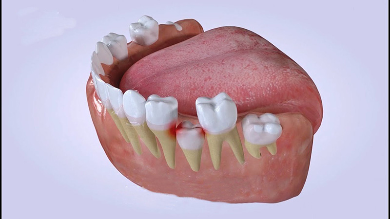 Khoảng 12 - 13 tuổi răng sữa sẽ rụng dần