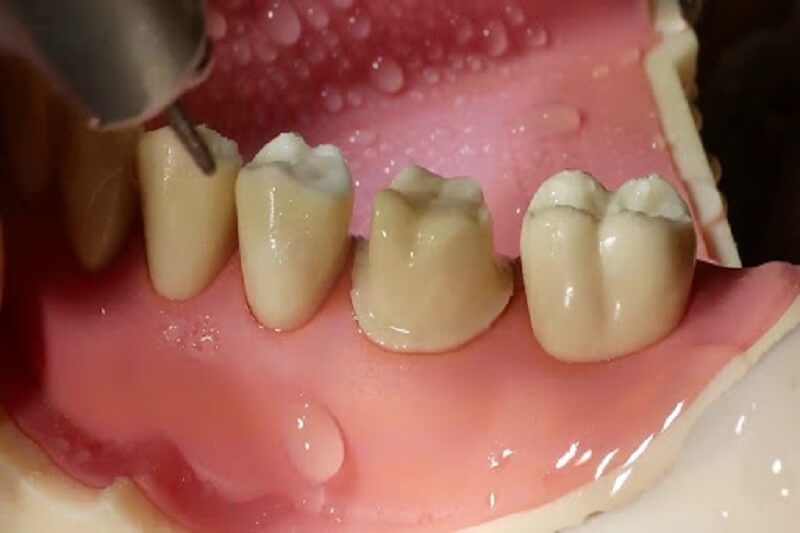 Mài cùi răng là công đoạn rất quan trọng trong quy trình bọc răng sứ