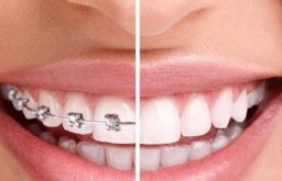Nên niềng răng hay bọc răng sứ - Cách chọn phương pháp tốt nhất