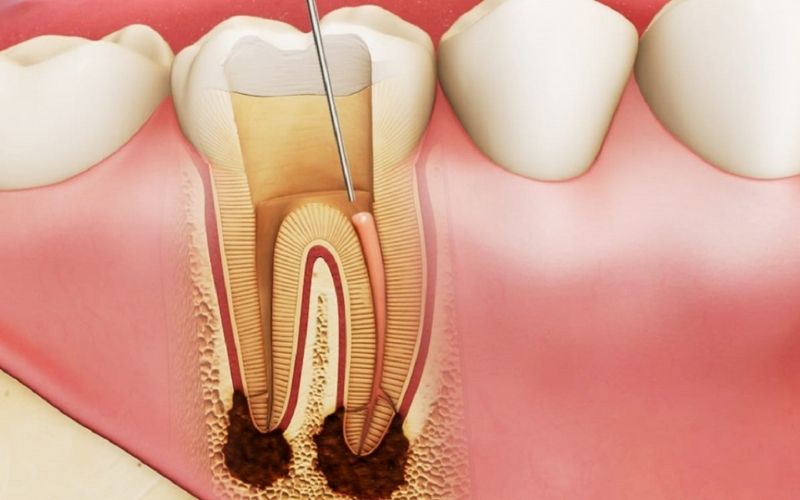 Bác sĩ sẽ chỉ định nhổ trong trường hợp răng bị sâu nặng và ăn vào đến tủy răng không thể khắc phục được