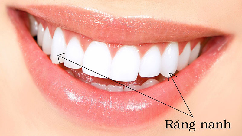 Răng nanh thuộc nhóm răng phía trước, nằm ở vị trí thứ 3 từ răng cửa mỗi bên