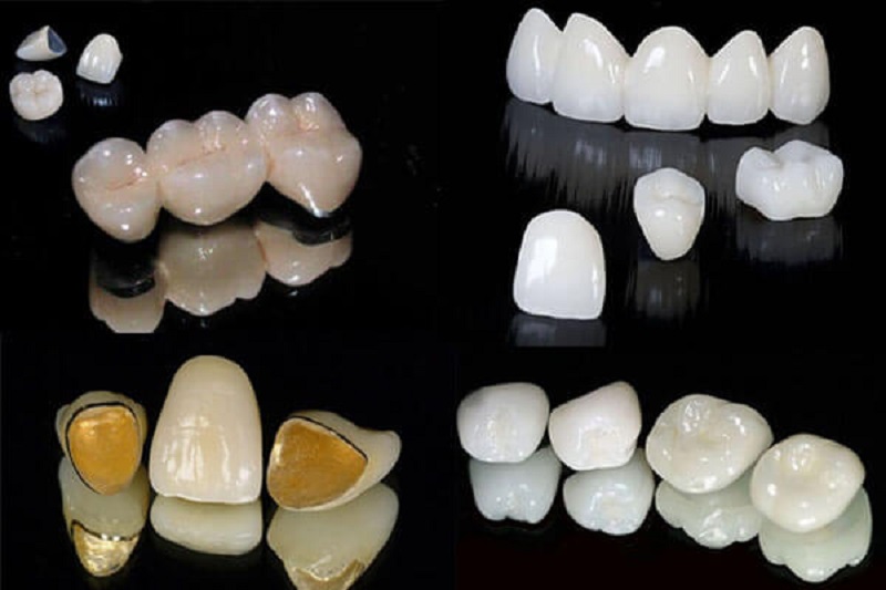 Chi phí bọc răng sứ trả góp phụ thuộc vào chất liệu mão sứ