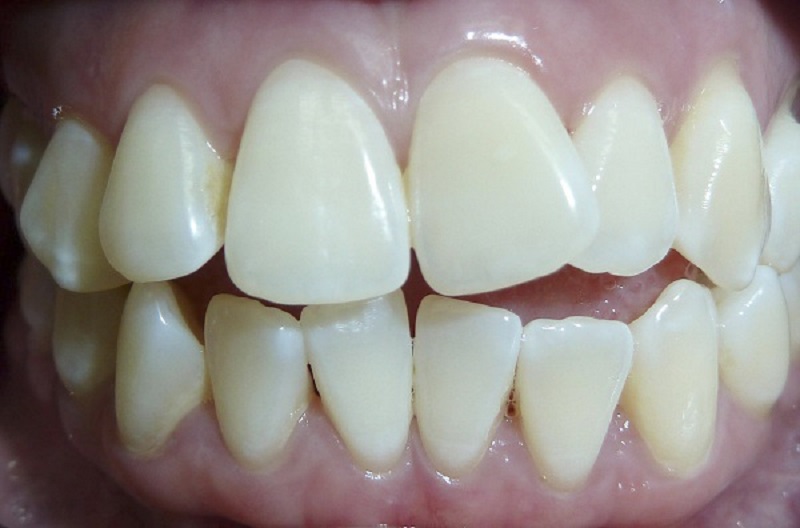 Khi nào nên bọc răng sứ - Khi răng bị khấp khểnh