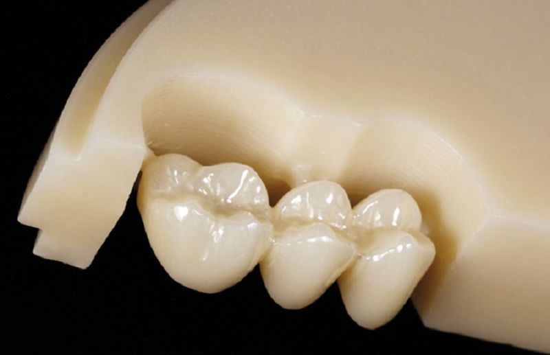 Răng sứ toàn sứ được làm từ sứ nguyên khối