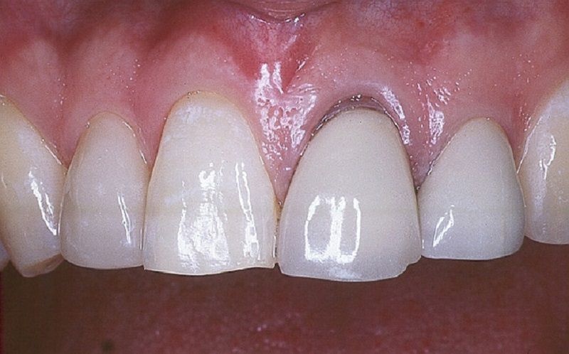 Răng sứ kim loại thường có nguy cơ bị oxy hóa