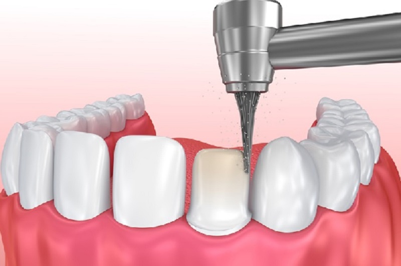Quá trình mài răng đòi hỏi sự cẩn trọng, tỉ mỉ của nha sĩ