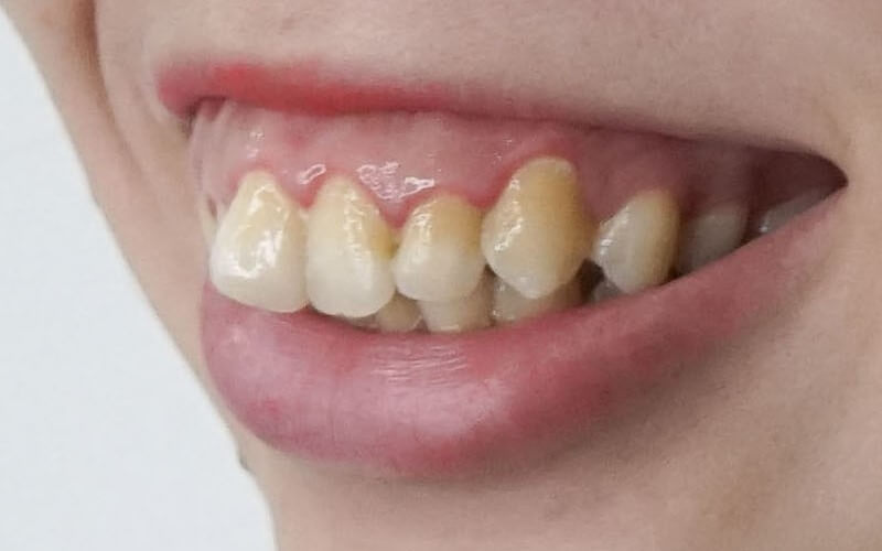 Nếu răng hô quá nhiều cần cân nhắc kỹ trước khi làm sứ