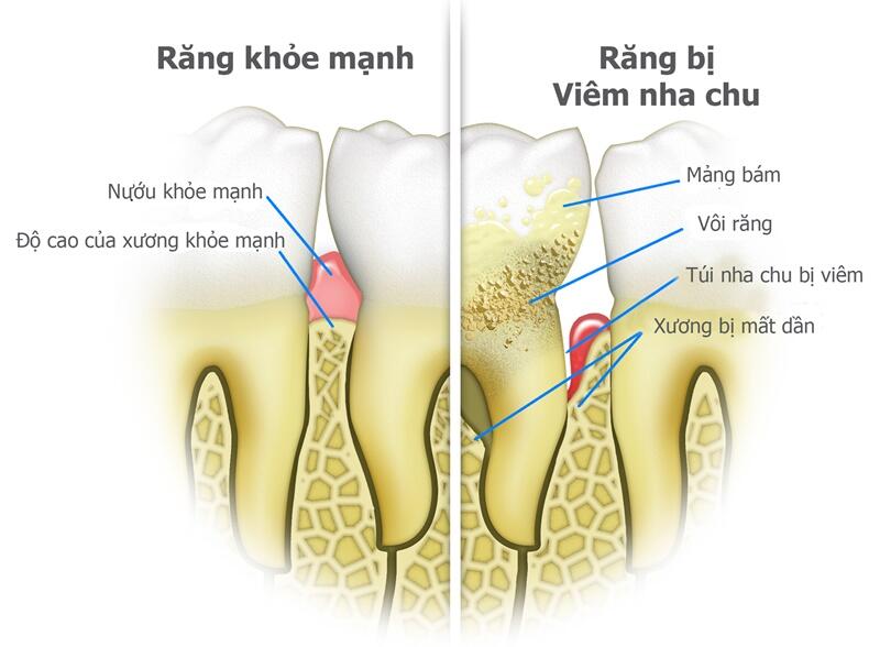 Khi phát hiện các dấu hiệu viêm nha chu, bạn nên đến gặp bác sĩ nha khoa sớm nhất