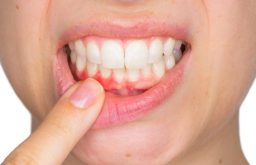 Nướu răng là gì và những vấn đề liên quan bạn nên tìm hiểu