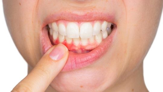 Nướu răng là gì và những vấn đề liên quan bạn nên tìm hiểu