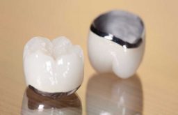 Quy trình bọc răng sứ chuẩn nhất bao gồm mấy bước? [Chi tiết]