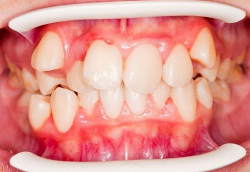 Răng khấp khểnh là gì
