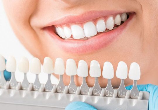 Trước và sau khi bọc răng sứ thẩm mỹ cần lưu ý những gì?