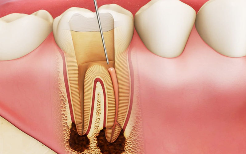 Chữa tủy răng nên được tiến hành sớm để bảo vệ được răng tự nhiên