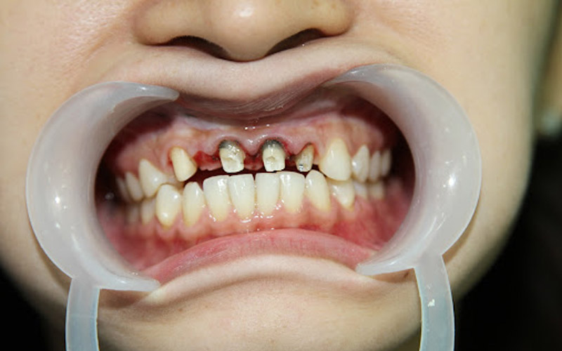 Răng bị sâu nặng, gây tổn thương đến tủy răng