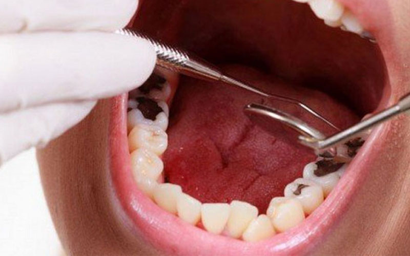 Chữ viêm tủy răng gần như không gây đau