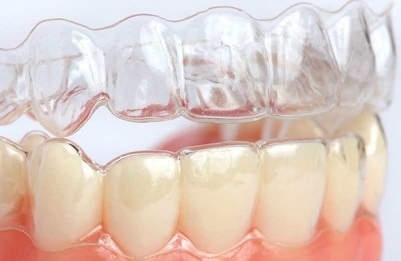 Niềng răng tháo lắp bằng 3D Clear được áp dụng phổ biến