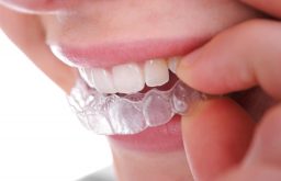 [Giải Đáp] Niềng răng tháo lắp có hiệu quả không? Phương pháp thực hiện