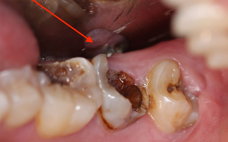 Viêm tủy răng có thể dẫn đến mất răng vĩnh viễn