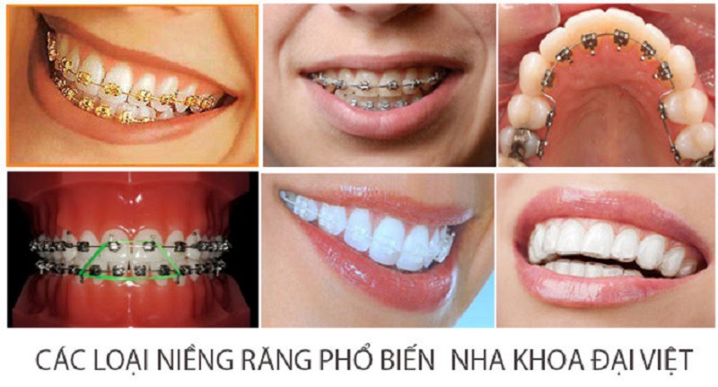 Mỗi phương pháp niềng răng sẽ có giá thành khác nhau