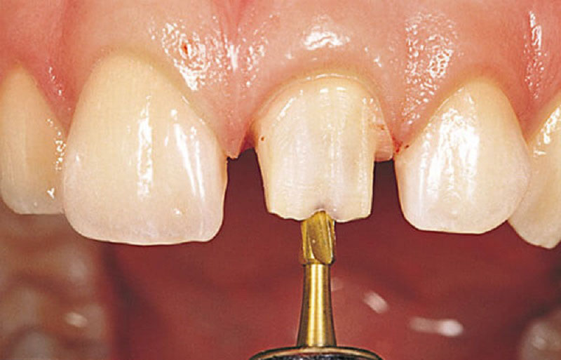 Lưu ý khi dùng các phương pháp phải mài đi lớp men của răng thật