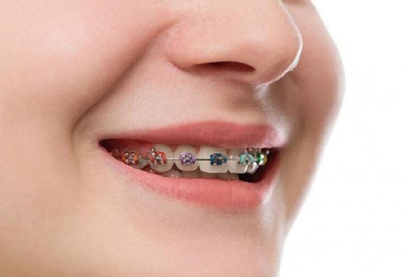 Niềng răng xong bị móm là tình trạng thường gặp ở nha khoa kém chất lượng