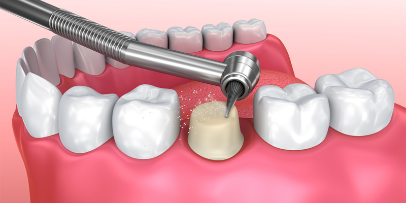 Bước tiến hành mài răng bọc sứ rất quan trọng, đòi hỏi bác sĩ có tay nghề chuyên môn tốt