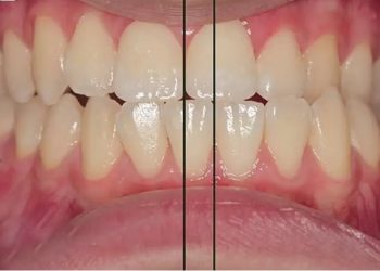 Răng lệch nhân trung là khuyết điểm bất cân xứng giữa hàm răng trên và hàm răng dưới