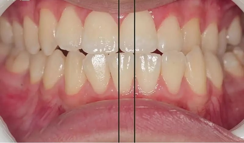 Răng lệch nhân trung là khuyết điểm bất cân xứng giữa hàm răng trên và hàm răng dưới
