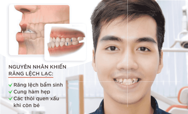 Nguyên nhân dẫn đến răng bị lệch nhân trung