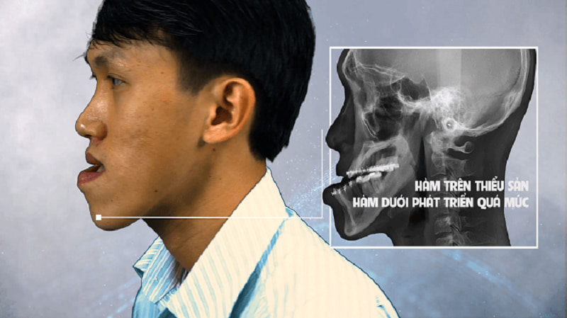 Hình ảnh móm xương hàm